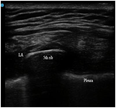 Continuous serratus anterior plane block for postoperative analgesia following lung transplantation via anterolateral incision: a pilot study